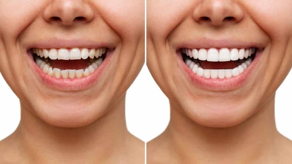 Contact Aspire White for teeth whitening services – Get in touch with Basingstoke today