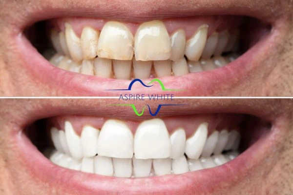 Achieve a radiant smile with professional laser teeth whitening Basingstoke